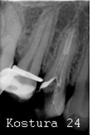відгалуження запломбованого  основного каналу зуба 24 на верхівці кореня.